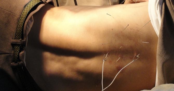 Acupuncture